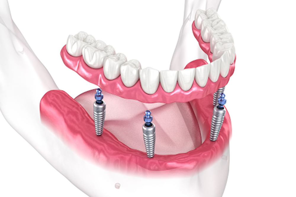 Dental Implants in Whitby for Multiple Missing Teeth